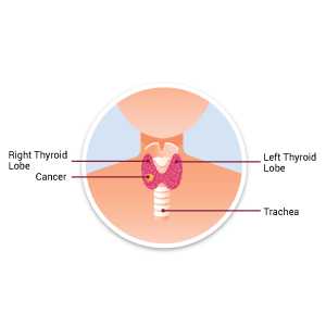 Thyroid Cancer Mobile