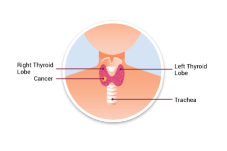 Thyroid Cancer Desktop